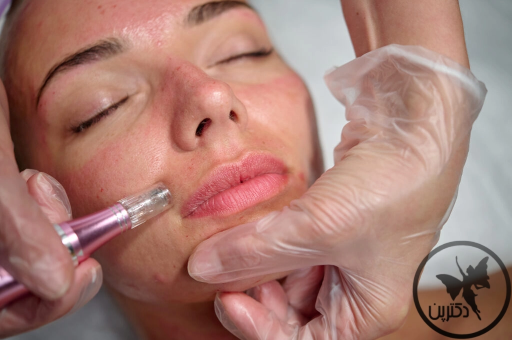 میکرونیدلینگ نکات پیشرفته و ترفندها